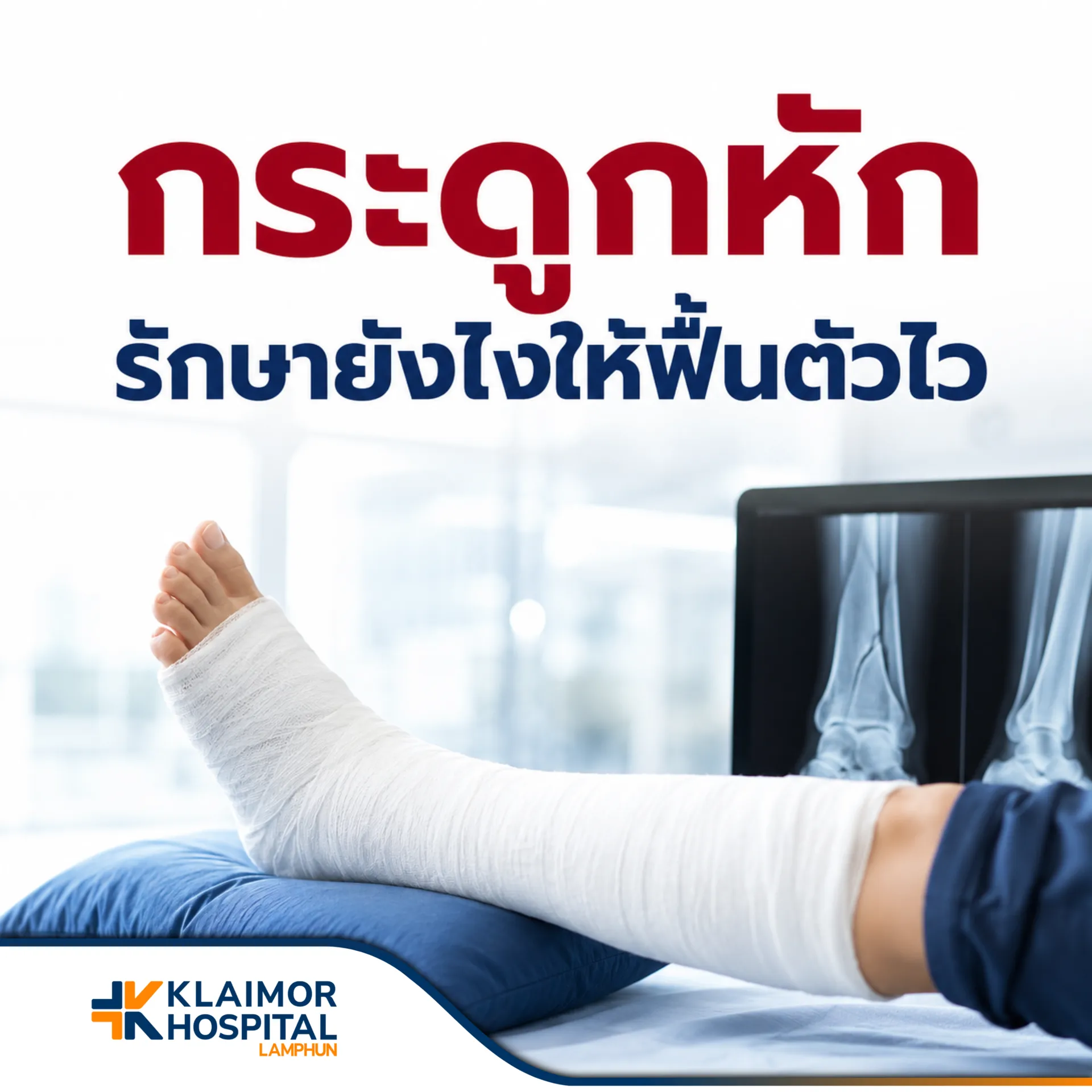 กระดูกหัก รักษายังไงให้ฟื้นตัวไวและตอบโจทย์ไลฟ์สไตล์