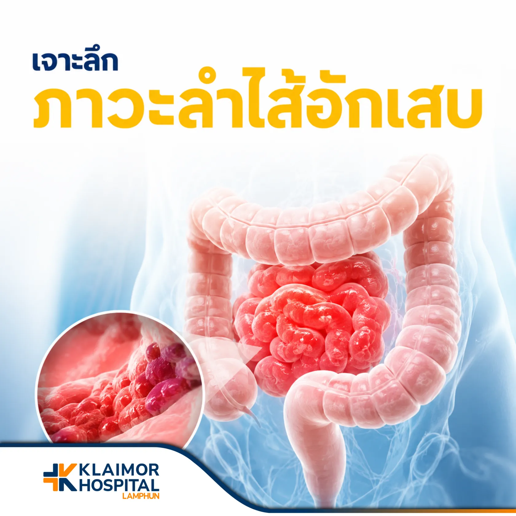 เจาะลึกภาวะลำไส้อักเสบ