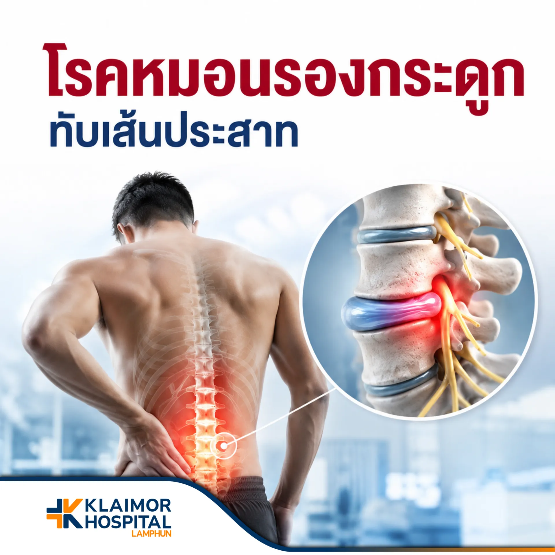 หมอนรองกระดูกกดทับเส้นประสาท