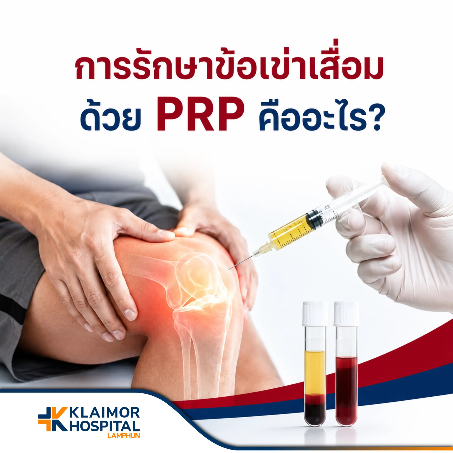 การรักษาข้อเข่าเสื่อมด้วย PRP คืออะไร