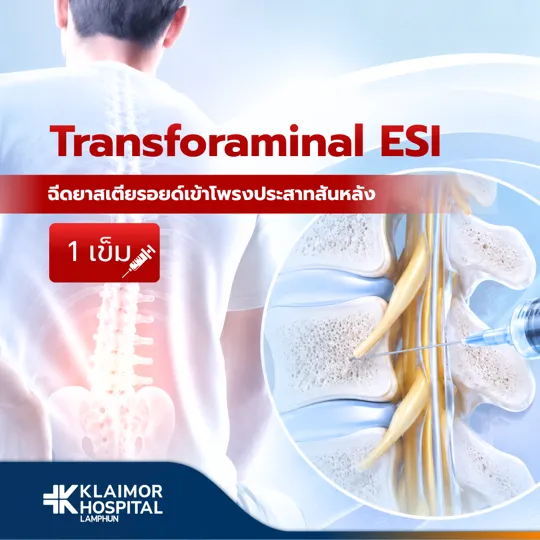 ฉีดยาสเตียรอยด์เข้าโพรงประสาทสันหลัง 1 เข็ม